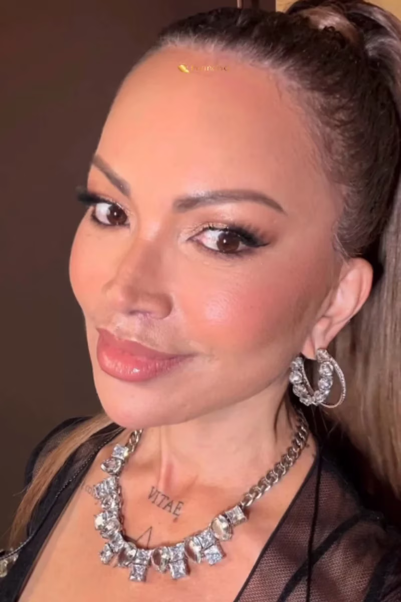 A cantora de 51 anos deu detalhes do procedimento e surpreendeu os internautas com a transformação no rosto