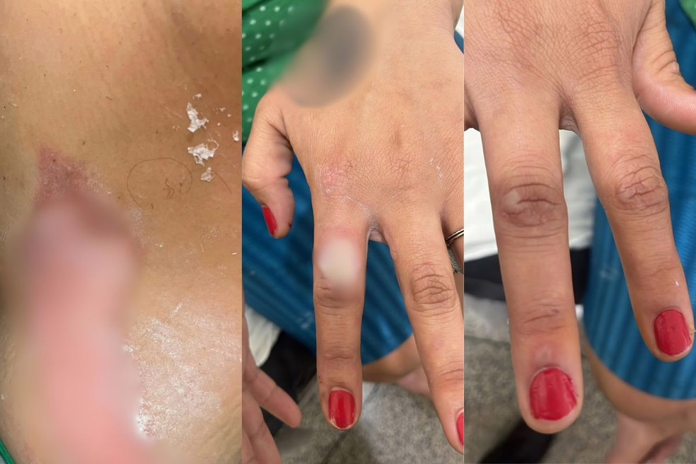 Vítima sofreu múltiplas queimaduras pelo corpo; ocorrência foi registrada em Bandeirantes