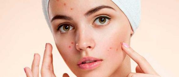 acne.jpg