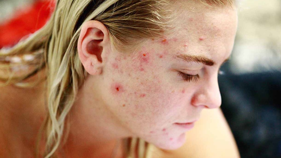 acne.jpg