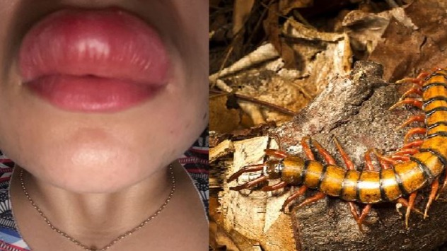 Menina fica com lábio imenso após ser picada por lacraia enquanto dormia em SP