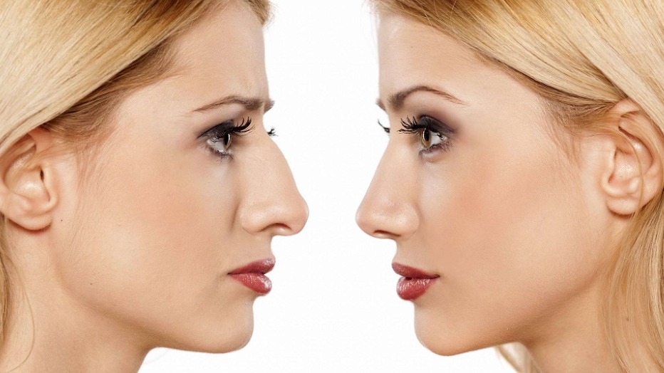 Rinoplastia
