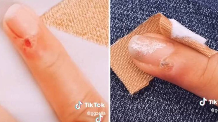 Vírus HPV usos lesão no dedo como "porta de entrada", em um caso raro, afirma médico