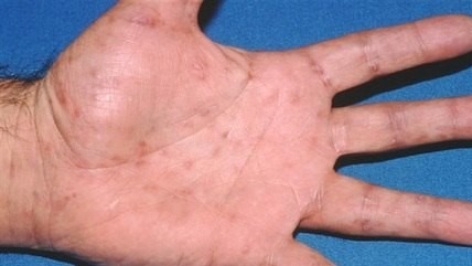 REPRODUÇÃO/JERE MAMMINO/AMERICAN OSTEOPATHIC COLLEGE OF DERMATOLOGY