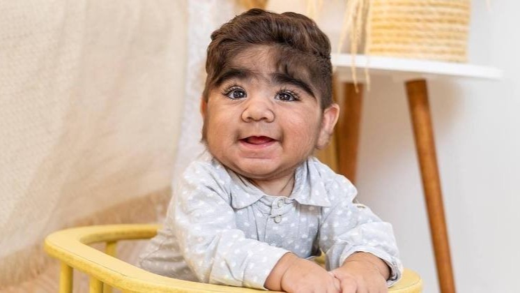 João Miguel nasceu com hipertricose REPRODUÇÃO/INSTAGRAM @BABYJOAO_MIGUEL1311