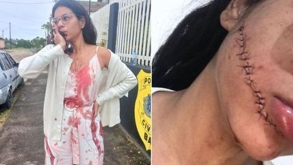 Stefani Firmo precisou levar 18 pontos no rosto REPRODUÇÃO/REDES SOCIAIS
