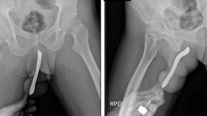  (crédito: Divulgação/Journal of Surgery Case Reports)