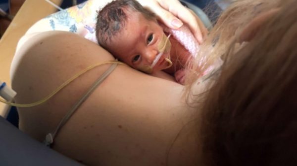 Bebê nasce com os orgãos expostos sobrevive com ajuda de filme PVC
