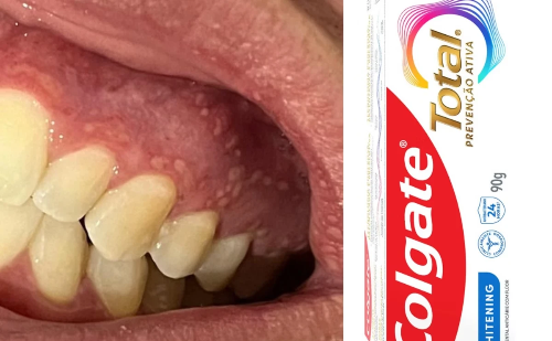 Linha de pasta de dente da Colgate é interditada pela Anvisa após casos de lesões bucais
