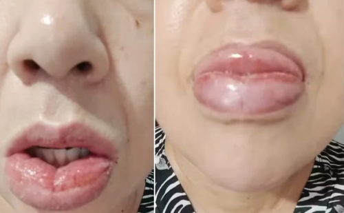 Mulher tem boca inchada e língua queimada após usar creme dental da Colgate