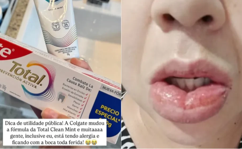 Mulher sofre reação alérgica grave após usar pasta Colgate e diz que vai processar a empresa