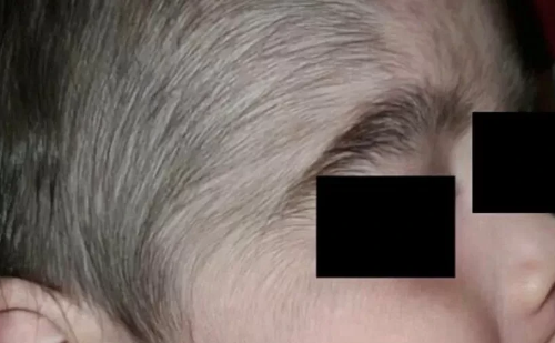 Anvisa alerta para risco de 'síndrome do lobisomem' em bebês expostos a minoxidil