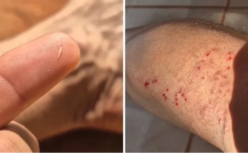 Pescador é surpreendido por sucuri e fica com dente preso no calcanhar