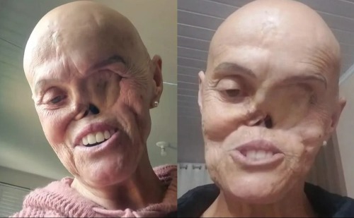 Aposentada enfrenta 27 anos de câncer de pele raro e já retirou 72 tumores