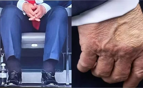 Hematomas nas mãos de Trump levantam especulações após novo aparecimento