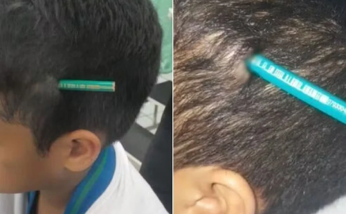 Aluno que cravou lápis na cabeça de colega é transferido de escola em Praia Grande (SP)
