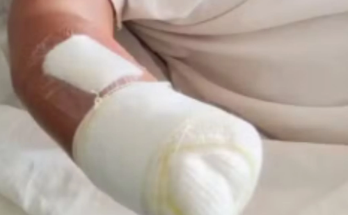 Mulher tem mão amputada ao ser golpeada com foice e facão pelo marido