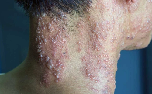 Vacina contra herpes zóster pode ser incluída no SUS; consulta pública é aberta